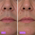 Cyperglow™ - Cyperus Rotundus Serum